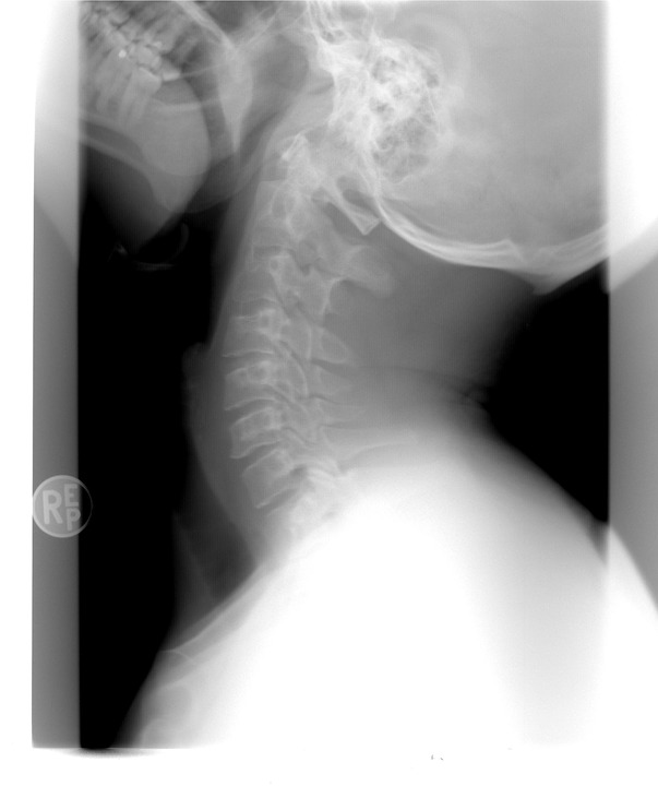 radiografía cervical