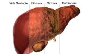 estados hígado de sano a enfermo